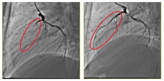冠狀動脈的左前降支完全阻塞，看不見血管（左紅圈處）。裝置血管內支架後，血流恢復暢通（右紅圈處）。