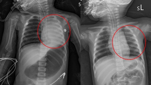 左圖是治療前可以看到左邊的肺部都塌陷變白右圖是治療侯可以看到左右兩邊的肺部都正常