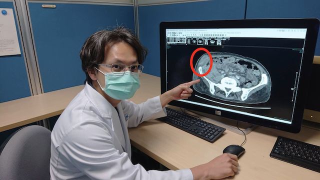 放射科黃竣聖醫師指出電腦斷層呈現疑似8公分腹腔內腫瘤