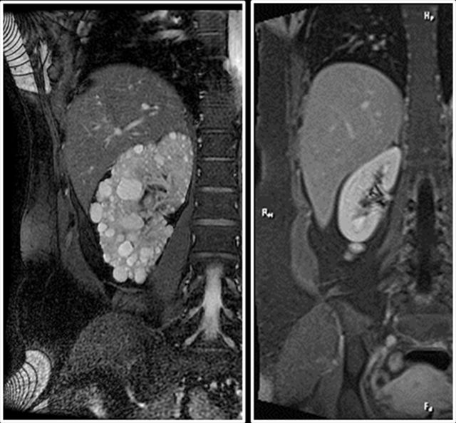 圖說：磁振造影下，左圖為多囊腎，右圖為正常腎臟。