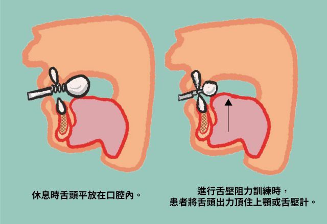 吞嚥肌群的訓練包含舌頭阻力訓練