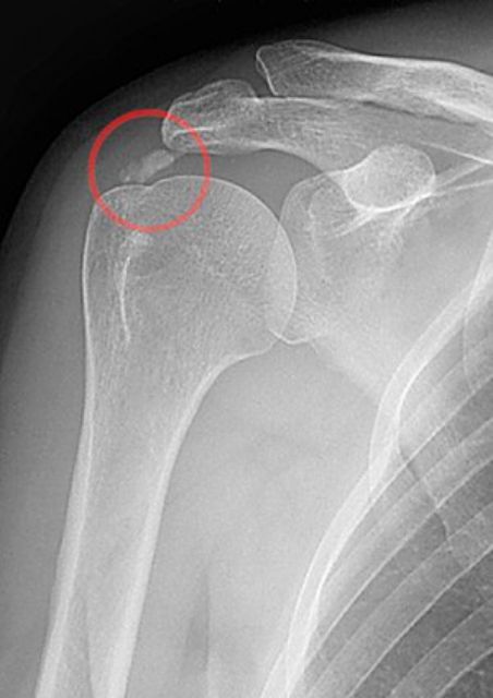 X光檢查—鈣化有點類似骨頭，因此X光照下去也是白白一塊。