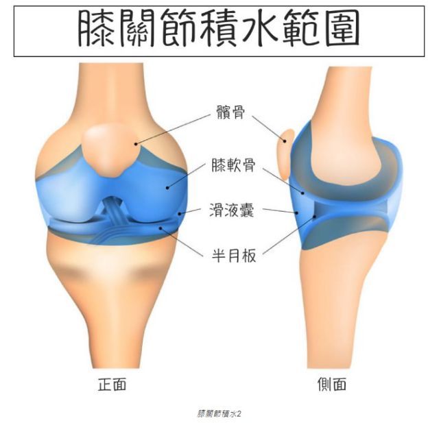 膝關節積水2