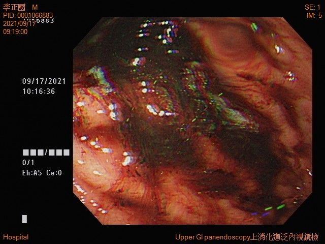 ▼放射治療前胃鏡影像 