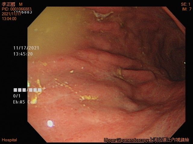 ▼放射治療後的第2天胃鏡影像
