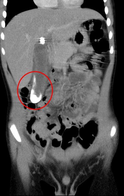 紅色圈起處為發炎腫脹的膽囊，白色部分為膽結石