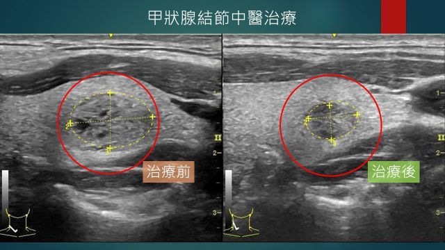 王先生接受甲狀腺節結中醫治療前後超音波檢查影像。