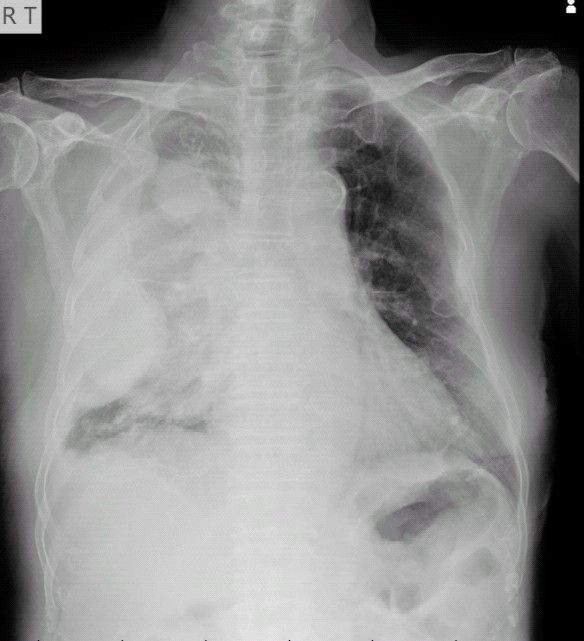 圖2、病患右側肺部有肺炎及疑似腫瘤的狀況。