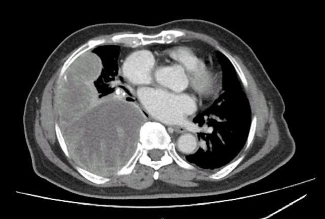 圖3、經電腦斷層掃描檢查後發現右側肺部有多處肋膜腫瘤及大量肋膜積水情形。