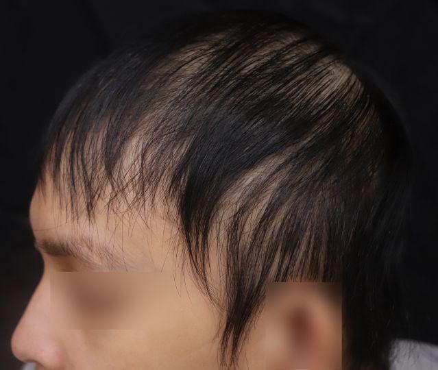 施打COVID-19疫苗一周後出現瀰漫性掉髮