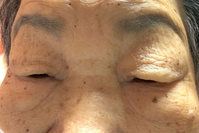 ▼住院治療前，陳姓阿嬤的眼皮明顯水腫下垂，甚至影響視線。