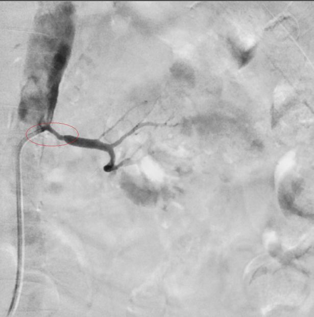圖說：1.血管攝影顯示左腎動脈狹窄(紅圈處)。