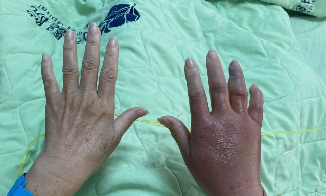 王太太右手被魚刺傷，感染海洋弧菌而出現紅腫痛症狀