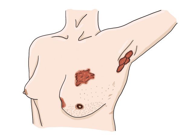 乳房皮膚有潰瘍或橘皮狀變化