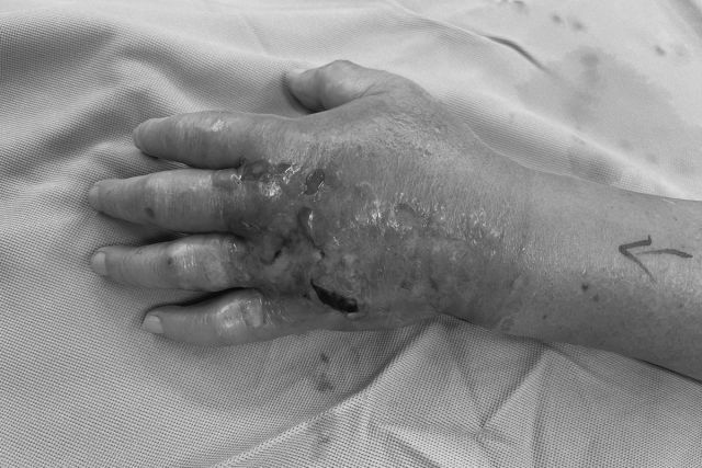 ▼吳先生因被魚刺刺傷造成壞死筋膜炎，手掌呈現腫脹。