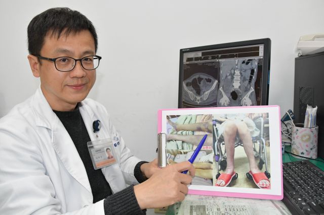 臺中醫院血液腫瘤科主任林俊良醫師表示，多活動是避免靜脈功能不全最好的解方