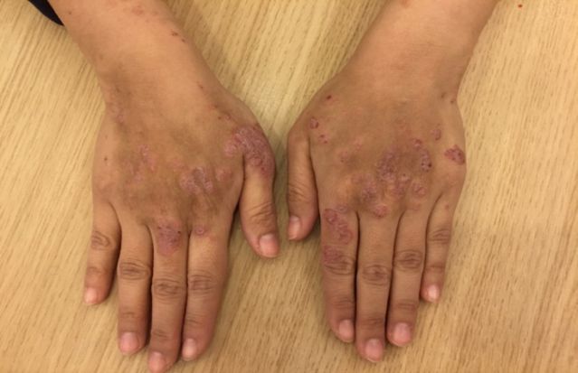 圖一、紫質症患者曝曬陽光下引起皮膚疹子