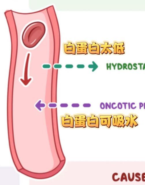 下肢水腫