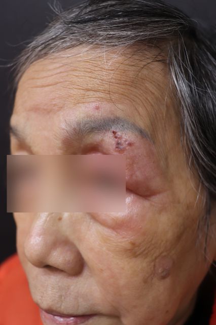 ▼林子凱主任提醒，帶狀皰疹發生在頭臉部三叉神經，恐影響到視網膜甚至失明。