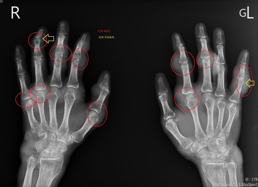 ▼痛風患者手部X光片，紅圈為痛風石，黃色箭頭為遭破壞骨頭。