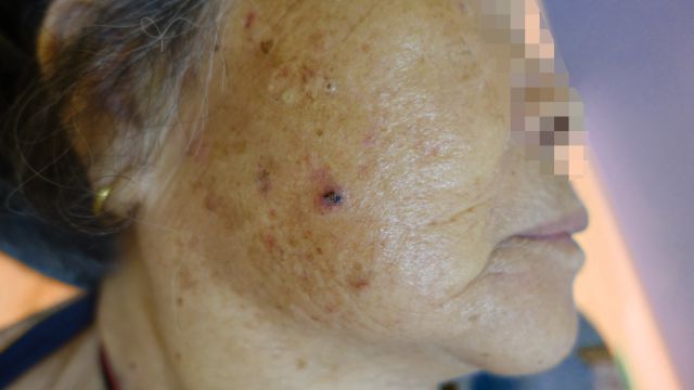 80多歲老婆婆患「鱗狀細胞癌」