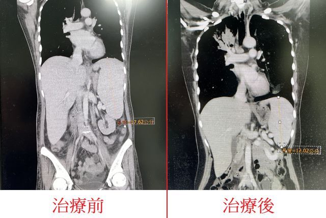 ▼電腦斷層檢查畫面－治療前後的脾臟變化，原本脾臟腫大約有17.6公分（red arrow right）治療五個月後縮小變成約12公分，減少約5.6公分