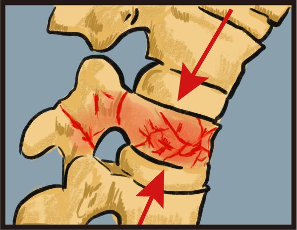 壓迫性骨折：僅影響到脊椎前三分之一的部份，屬於穩定性骨折