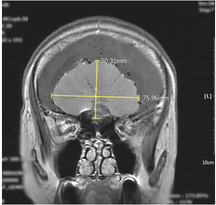 核磁共振顯示邱女士顱內出現8公分大腦膜瘤。