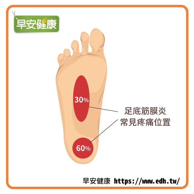 足底筋膜炎常見疼痛位置