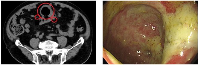 左圖：電腦斷層顯示大腸已有多處憩室，右圖：大腸鏡發現憩室已發炎潰爛。
