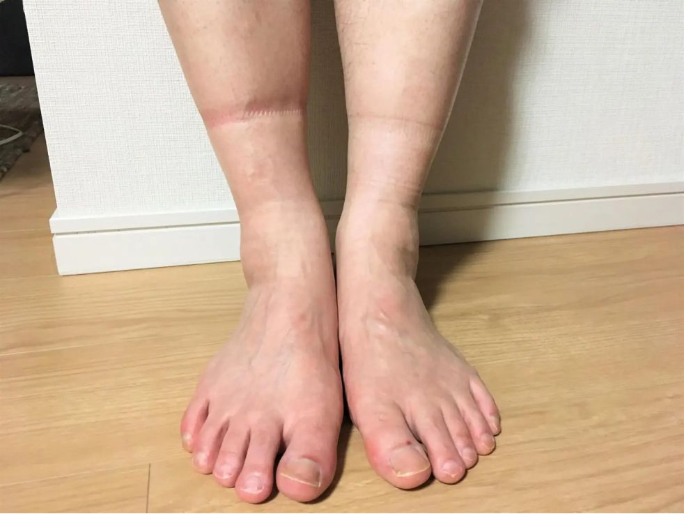 如果是腳腫的情況，第一件事要先判斷是一隻腳還是兩隻腳腫，兩個原因大不同，如果是兩腳腫，抬腳墊高也無法明顯消掉的話，建議可以就診評估檢查；而如果是單腳腫的話，建議就醫評估。
