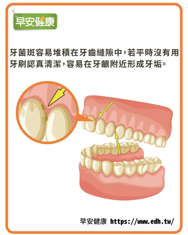 牙菌斑容易堆積在牙齒縫隙中，若平時沒有確實做好清潔，容易在牙齦附近形成牙垢