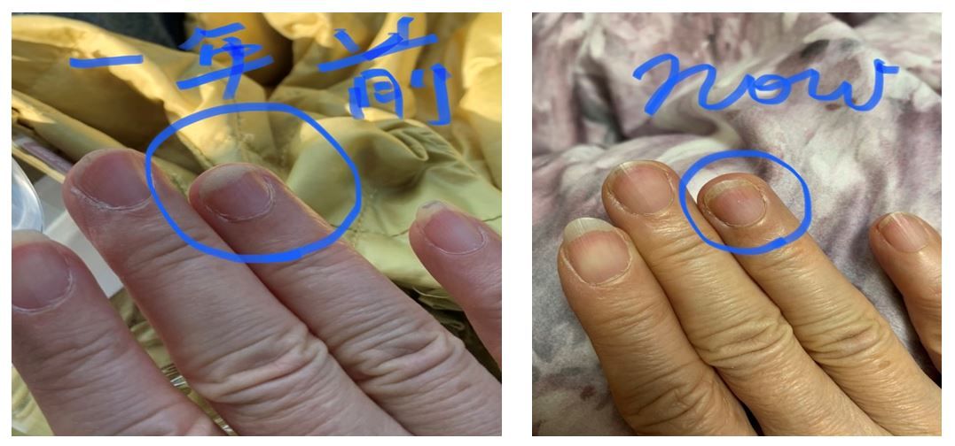 缺維生素D的跡象：手指甲與指甲床連接的部分越來越短