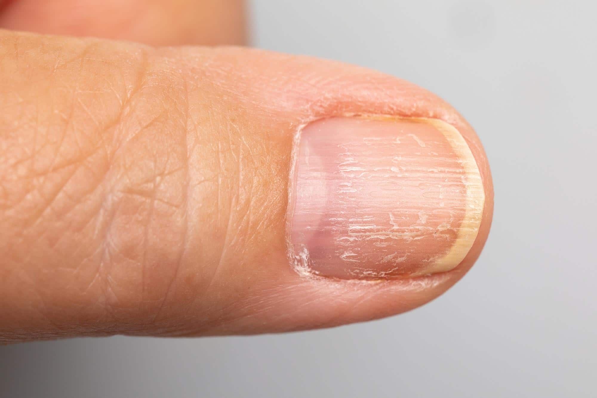 指甲缺乏維生素A、鋅、鈣或鐵：直線條紋