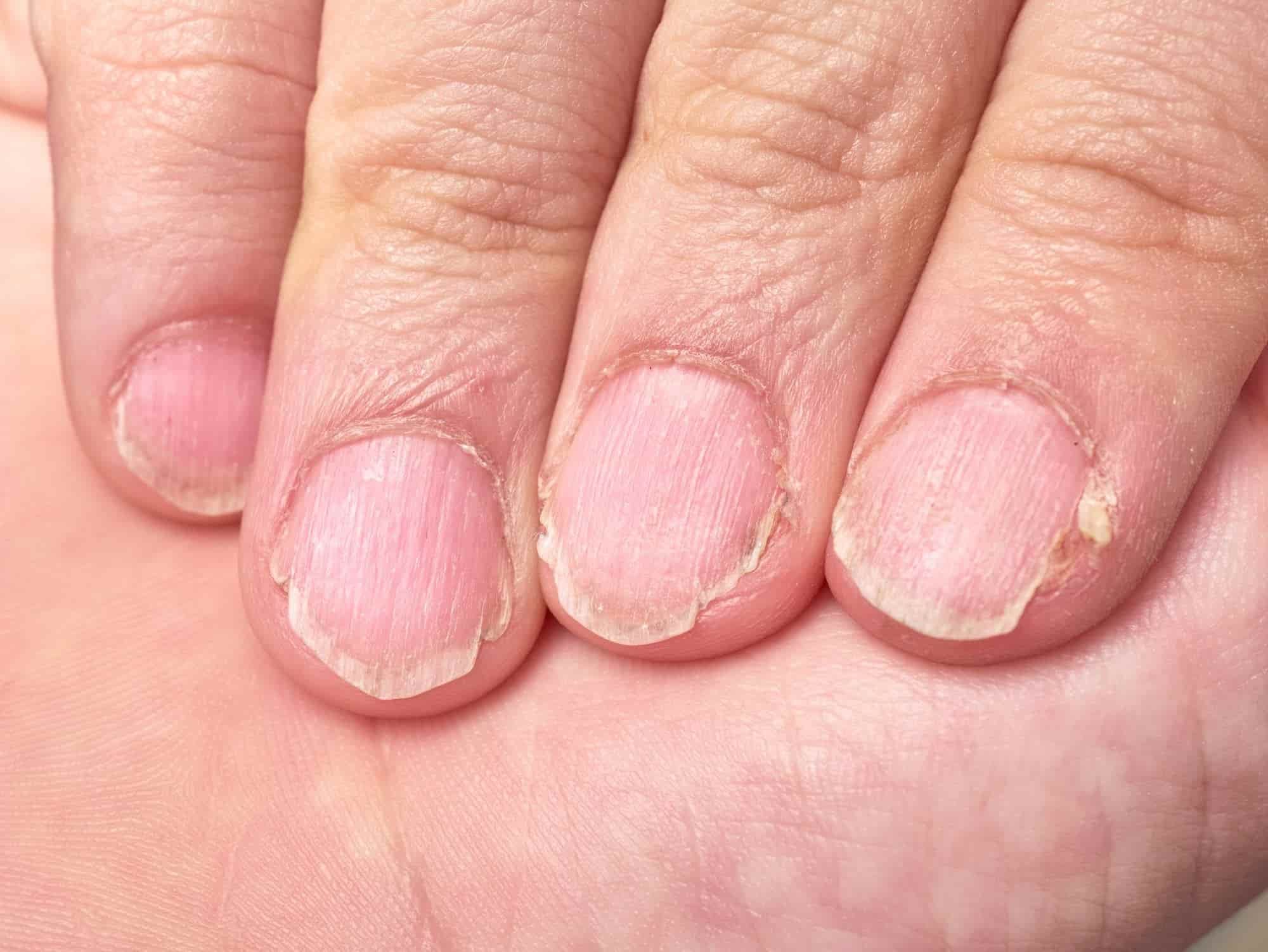 指甲缺乏維生素B群、鈣質、鐵或脂肪酸：指甲脆弱、斷裂、易碎