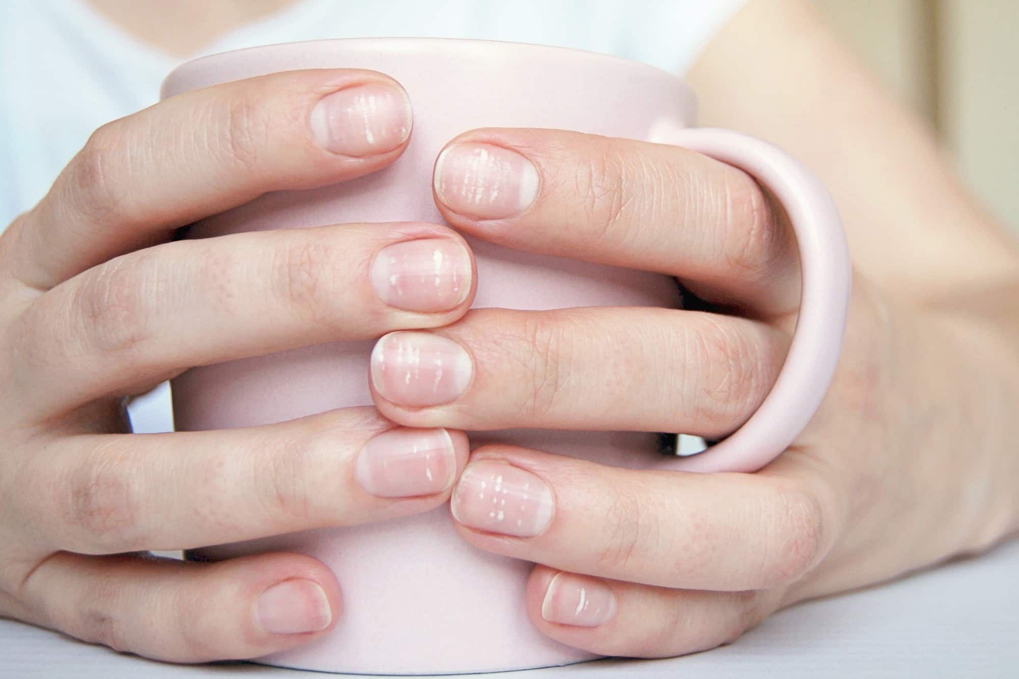 指甲缺乏鋅鐵鈣：白點、白線、白斑