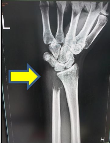 手腕X光呈現遠端尺骨已被腫瘤完全吃掉