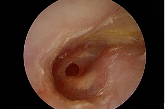 病人耳膜破損範圍占耳膜的15％，且經常出現分泌物、疼痛。