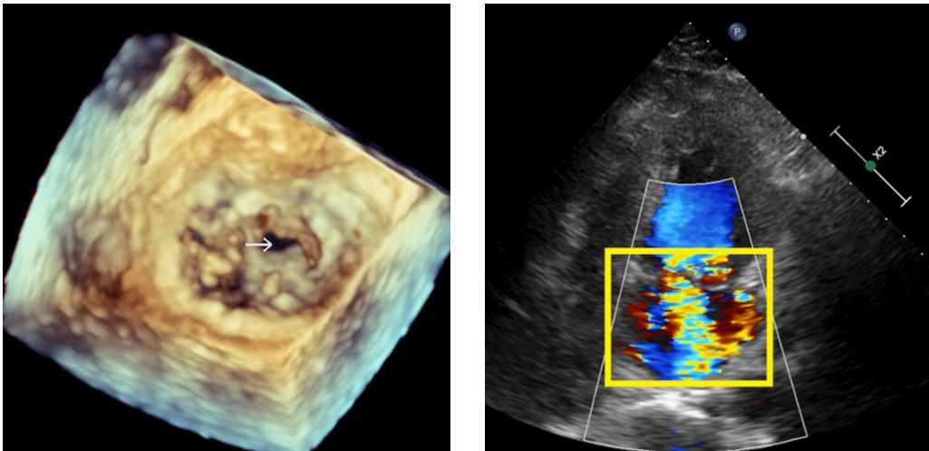 食道超音波看到蔡先生的二尖瓣有一個1公分大的破損(左圖箭頭處)；超音波顯像中看到逆流的血液(右圖黃框處)。