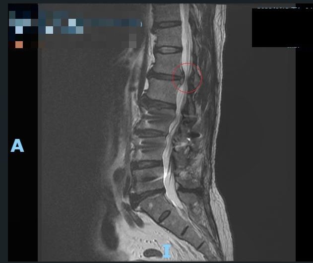 圖說：核磁共振顯示詹先生的腰椎第一及第二節之間的椎間盤突出。賴肇康主任。詹先生。