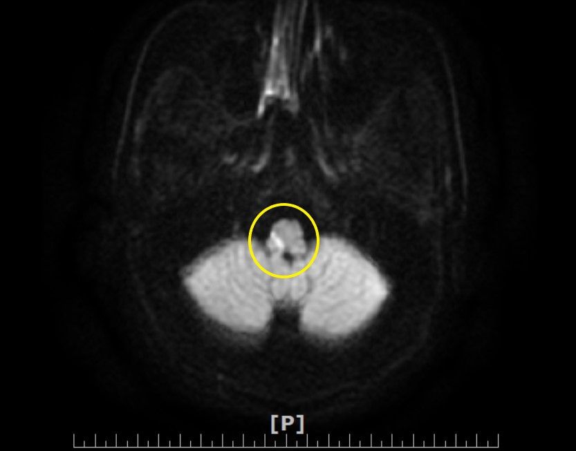 核磁共振影像，黃圈處為延腦梗塞處