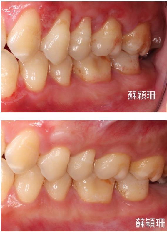 術前因牙齦退縮，牙齒明顯變長(上圖)；透過「皮下結締組織移植術」執行牙根覆蓋手術，牙齦長回正常的厚度、高度。(下圖)