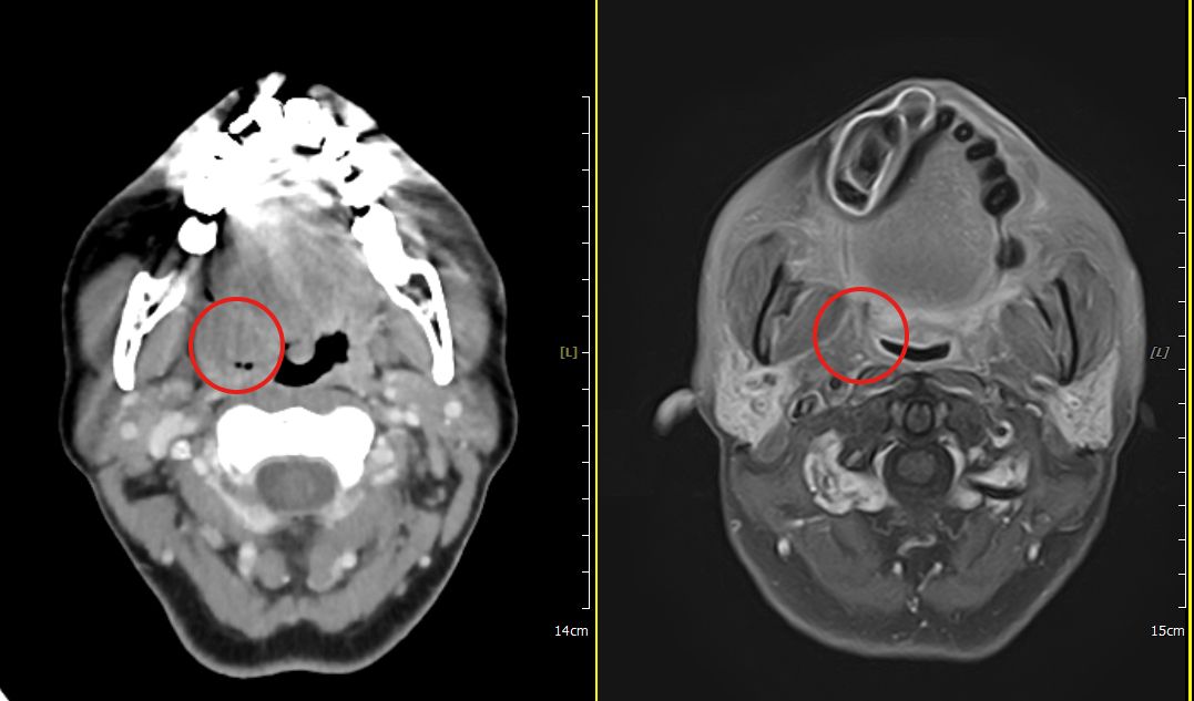 快活光子刀治療後，右圖顯示扁桃腺腫瘤完全消失，左圖為治療前腫瘤情形。