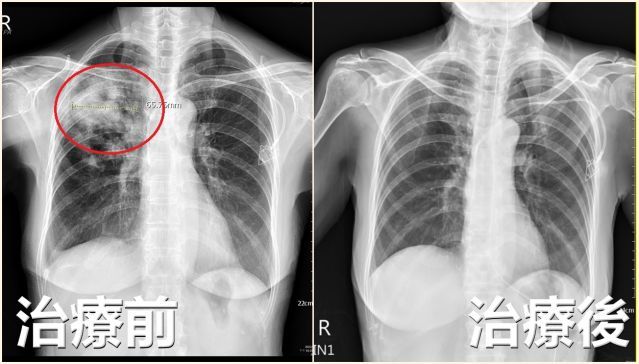 患者X光檢查影像顯示右上肺葉發炎，宛如「開了一個洞」。