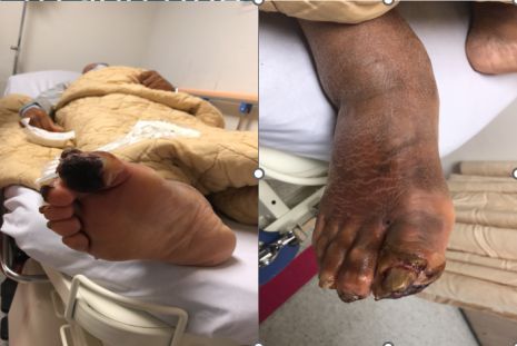 阿嫲右腳大姆指突然變黑，伴隨疼痛感，經診斷是慢性肢體威脅性缺血，Rutherford第五級。