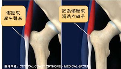 彈響髖症候群-髂脛束（張擴筋膜肌）摩擦到外側大轉子