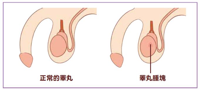 睪丸癌(右)摸起來表面會有硬塊和不平滑的感覺