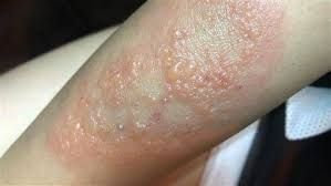 隱翅蟲傷口可能出現紅疹、水泡