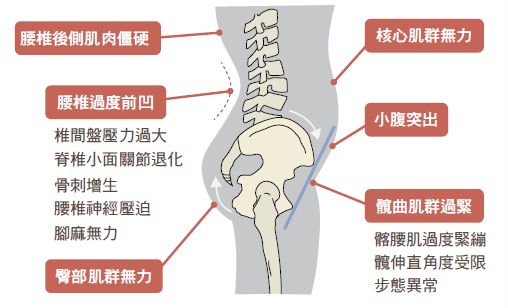 首先，骨盆前傾的姿勢會導致腰椎向前凹，當曲度過大時會讓腰後側的肌肉緊繃僵硬，出現下背痠痛的症狀，日積月累下還會導致椎間盤因為受壓不均而退化。另外，每一節腰椎之間的關節面，也可能因不當受力而磨損，甚至增生骨刺，進而壓迫到腰椎神經，造成屁股痠痛、腳麻無力或走路不穩等問題。