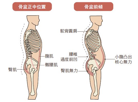 其實骨盆前傾，是一種身體關節的活動方向，本來就是完全正常且必要的動作，無論是彎腰撿東西、坐下、站立，甚至是行走，骨盆前傾都會參與其中。真正的問題其實是久坐辦公族，已經讓前傾所導致的「肌肉不平衡」變成生活常態，導致身體逐漸失去正常的靈活度，無法自由地改變骨盆角度，這才是問題的來源！